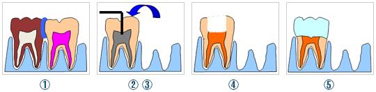 歯牙移植について