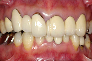 審美的歯科治療の症例01　術前