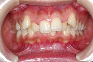 歯周病治療の症例02 矯正前