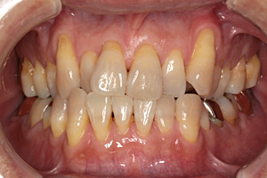 歯周病治療の症例03 矯正前