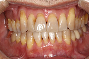 歯周病治療の症例03 矯正後
