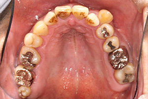 歯周病治療の症例04 矯正前