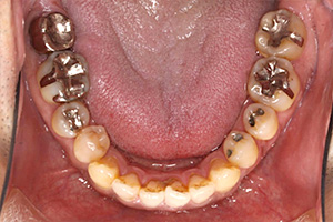 歯周病治療の症例04 矯正前