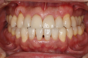 歯周病治療の症例04 矯正後