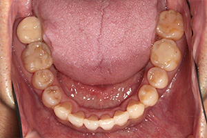 歯周病治療の症例04 矯正後