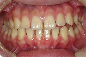 歯周病治療の症例05 矯正前
