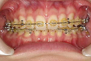 歯周病治療の症例05 矯正中
