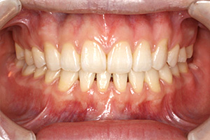 歯周病治療の症例05 矯正後
