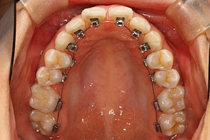歯周病治療の症例04 矯正中