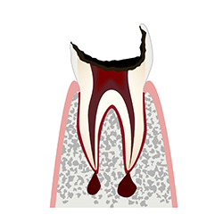 虫歯レベル4（C4）